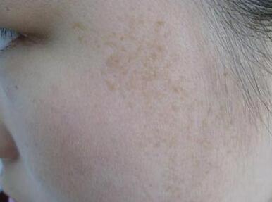 雀斑治疗要花多少钱