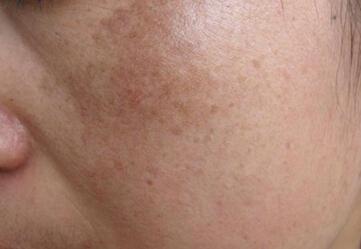 �ƺְ�֢״������Щ��