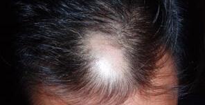 植发可以治疗疤痕性脱发吗