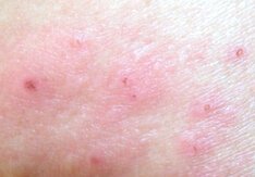 皮炎患者该如何护理肌肤