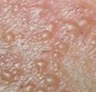 湿疹发病有哪些症状表现