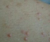 平时多做运动帮助预防毛囊炎