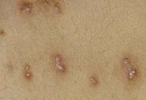 �괯��������Щ��ͬ��֢״