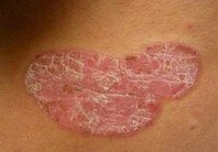 ţƤѢ��������Щ֢״������