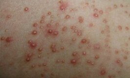 ë���׵�֢״������Щ