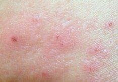 脸上感染了皮炎要如何护理