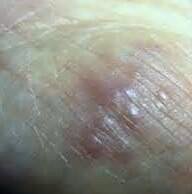 日常生活中该如何预防疥疮