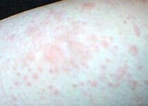 引发湿疹的原因有哪些