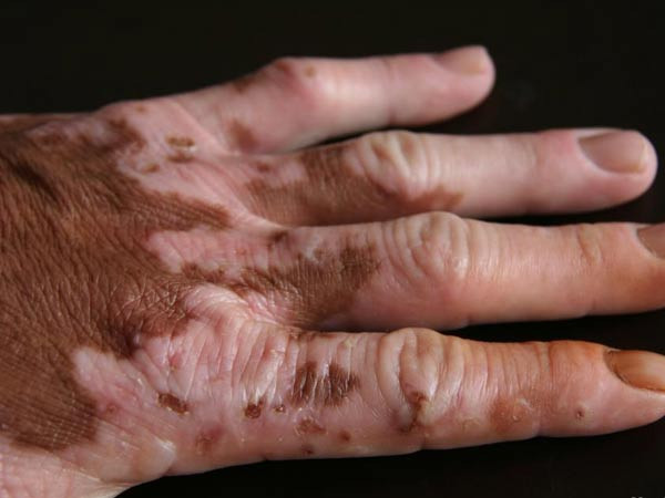 重庆哪里有白癜风医院