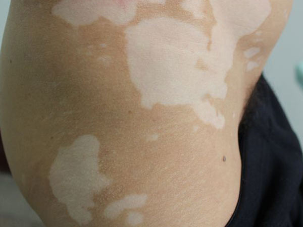 哪个重庆医院治疗白癜风