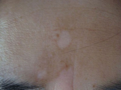 哪家重庆医院治白癜风好