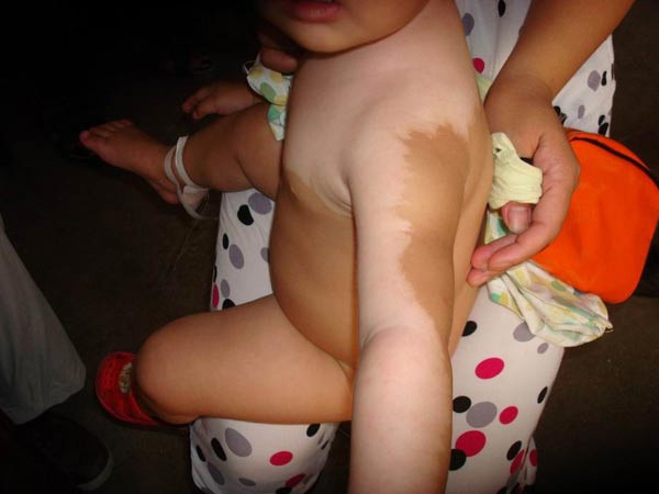 哪个重庆医院看白癜风好