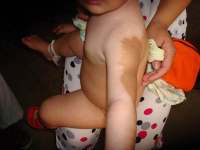 重庆哪家白癜风医院好