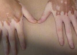 重庆哪个医院治白癜风