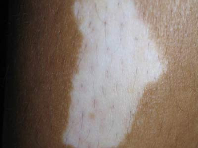 重庆看白癜风哪个医院好