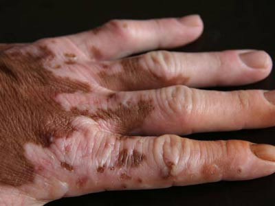 重庆哪家医院冶疗白癜风