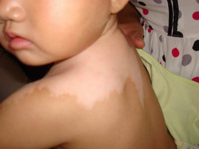 重庆脱发治疗哪个医院