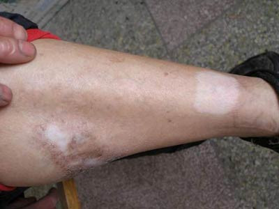 �����ĸ�ҽԺ��ʪ��