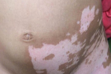 哪些重庆医院治疗脱发