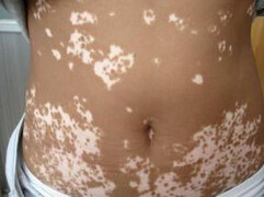 重庆扁平疣的治医院