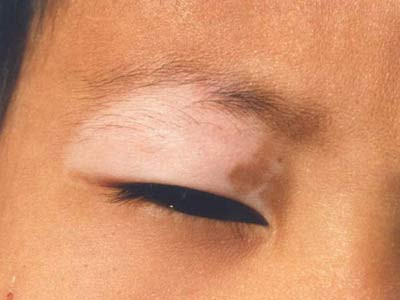 重庆扁平疣医院