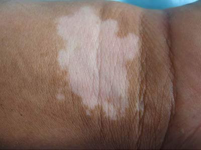 哪家重庆医院治脱发好