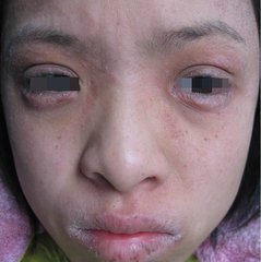 ����Ƥ����ʲô֢״