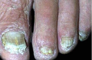 重庆治疗灰指甲哪里好