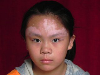 重庆治疗白癜风到哪里较好