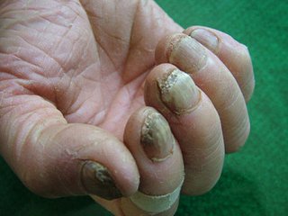 灰指甲是怎么形成的呢